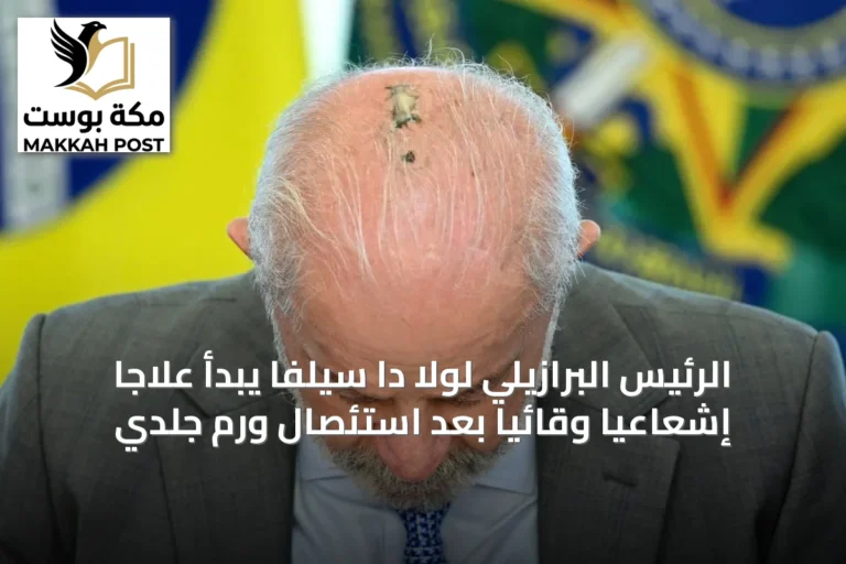 الرئيس البرازيلي لولا دا سيلفا يبدأ علاجاً إشعاعياً وقائياً بعد استئصال ورم جلدي
