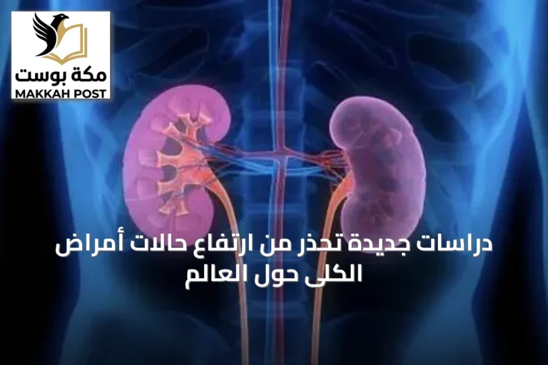 دراسات جديدة تحذر من ارتفاع حالات أمراض الكلى حول العالم