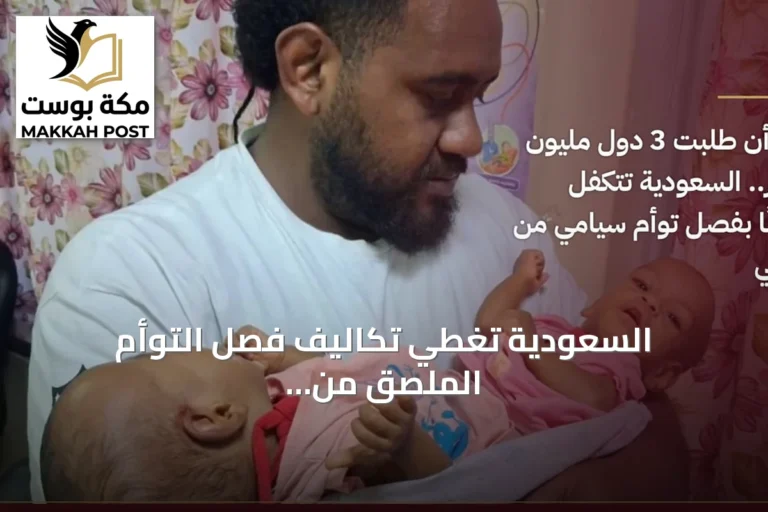 السعودية تغطي تكاليف فصل التوأم الملصق من فيجي دون مقابل