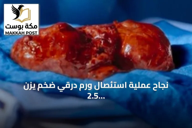 نجاح عملية استئصال ورم درقي ضخم يزن 2.5 كغم بمستشفى د. خالد الرحيمي دون فتح صدري